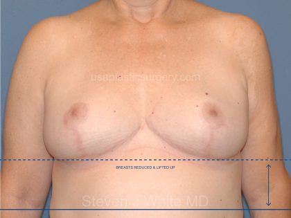 Breast Reduction Before & After Patient #3515