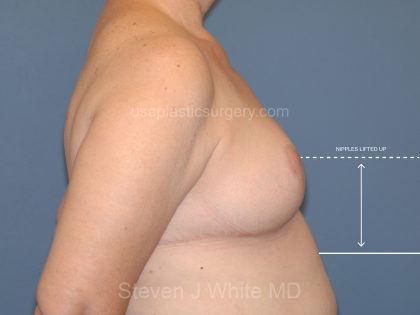 Breast Reduction Before & After Patient #3515