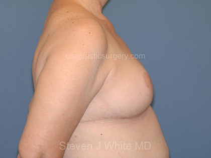 Breast Reduction Before & After Patient #3515