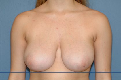 Breast Reduction Before & After Patient #3576