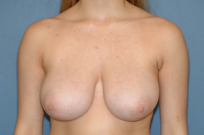 Breast Reduction Before & After Patient #3576