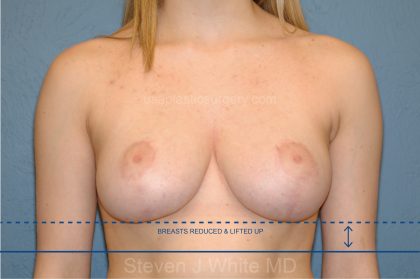 Breast Reduction Before & After Patient #3576
