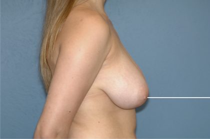 Breast Reduction Before & After Patient #3576