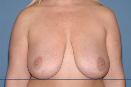Breast Reduction Before & After Patient #3577