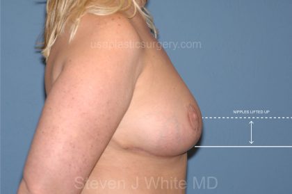 Breast Reduction Before & After Patient #3577