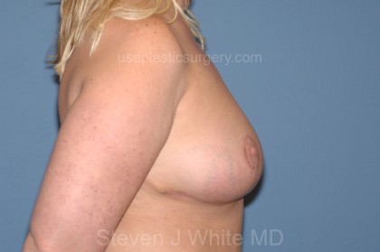 Breast Reduction Before & After Patient #3577