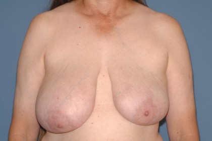 Breast Reduction Before & After Patient #3579