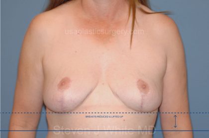 Breast Reduction Before & After Patient #3579