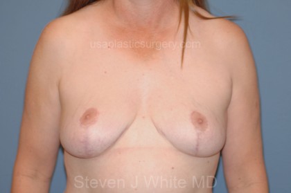 Breast Reduction Before & After Patient #3579
