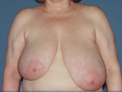 Breast Reduction Before & After Patient #3581