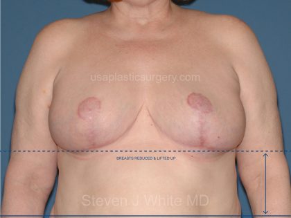 Breast Reduction Before & After Patient #3581