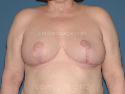 Breast Reduction Before & After Patient #3581