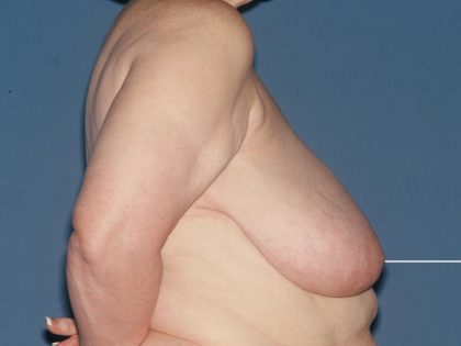Breast Reduction Before & After Patient #3581