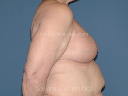 Breast Reduction Before & After Patient #3581
