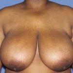 Breast Reduction Before & After Patient #3583