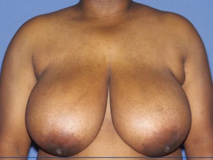 Breast Reduction Before & After Patient #3583
