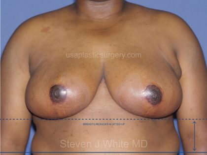 Breast Reduction Before & After Patient #3583
