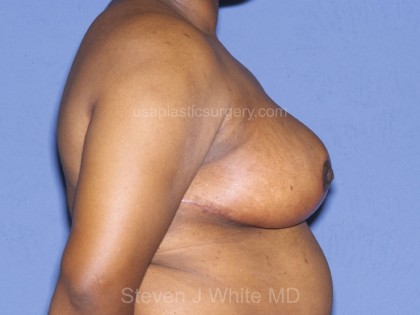 Breast Reduction Before & After Patient #3583