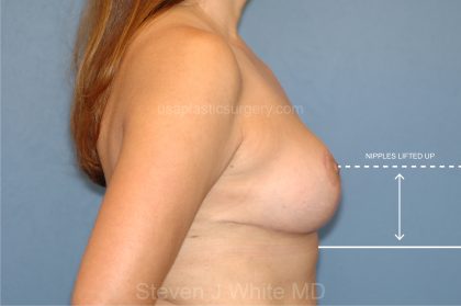 Breast Reduction Before & After Patient #3584