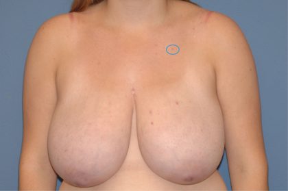 Breast Reduction Before & After Patient #3507
