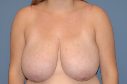 Breast Reduction Before & After Patient #3507