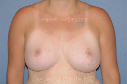 Breast Reduction Before & After Patient #3507