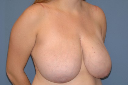 Breast Reduction Before & After Patient #3507