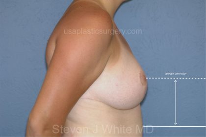 Breast Reduction Before & After Patient #3507
