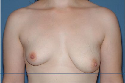 Breast Reduction Before & After Patient #3585