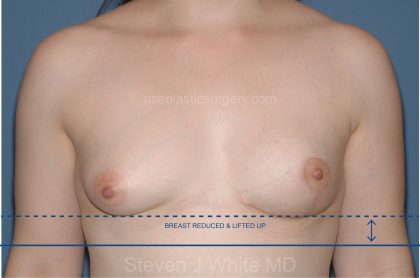 Breast Reduction Before & After Patient #3585