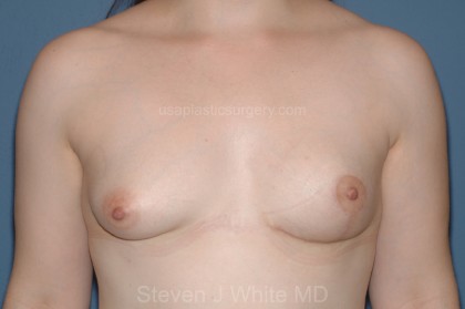Breast Reduction Before & After Patient #3585