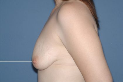 Breast Reduction Before & After Patient #3585