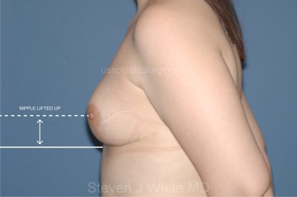 Breast Reduction Before & After Patient #3585