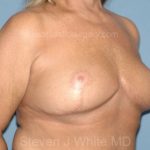 Breast Reduction Before & After Patient #3646