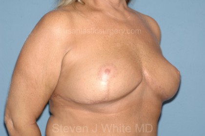 Breast Reduction Before & After Patient #3646