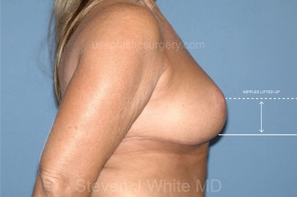 Breast Reduction Before & After Patient #3646