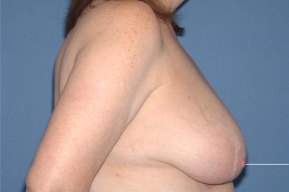 Breast Reduction Before & After Patient #3647
