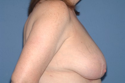 Breast Reduction Before & After Patient #3647