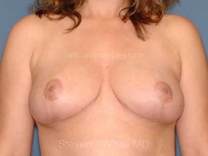 Breast Reduction Before & After Patient #3649