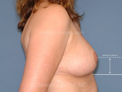 Breast Reduction Before & After Patient #3649