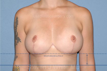 Breast Reduction Before & After Patient #3650