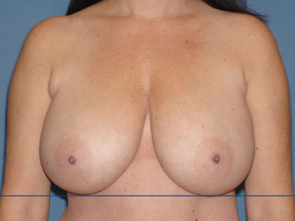 Breast Reduction Before & After Patient #3651