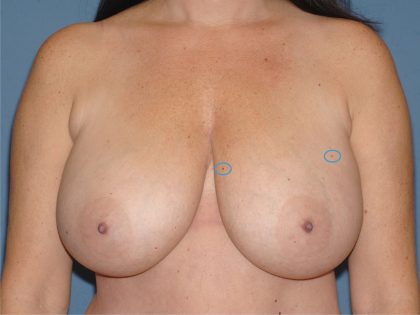 Breast Reduction Before & After Patient #3651