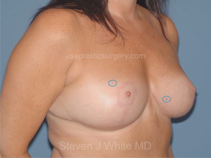 Breast Reduction Before & After Patient #3651