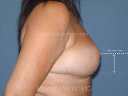 Breast Reduction Before & After Patient #3651