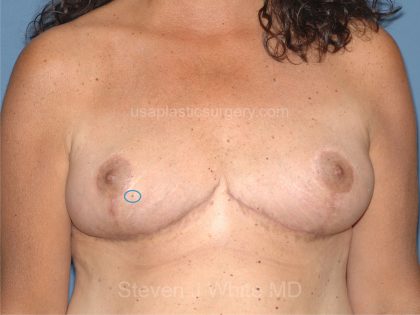 Breast Reduction Before & After Patient #3652