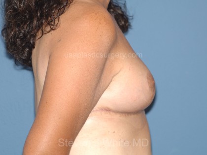 Breast Reduction Before & After Patient #3652