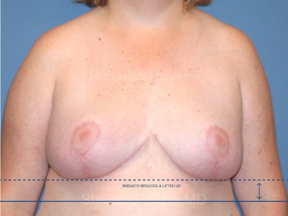 Breast Reduction Before & After Patient #3654