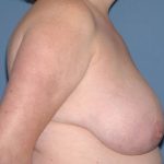 Breast Reduction Before & After Patient #3654