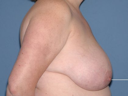 Breast Reduction Before & After Patient #3654